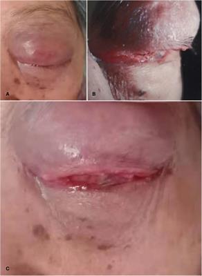 Conjunctival squamous cell carcinoma with massive apoptosis and immune cell infiltration: A case report